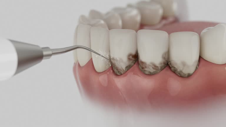 Trusted Dental Implants service in Deerfield Beach, FL - Dentist Open Now